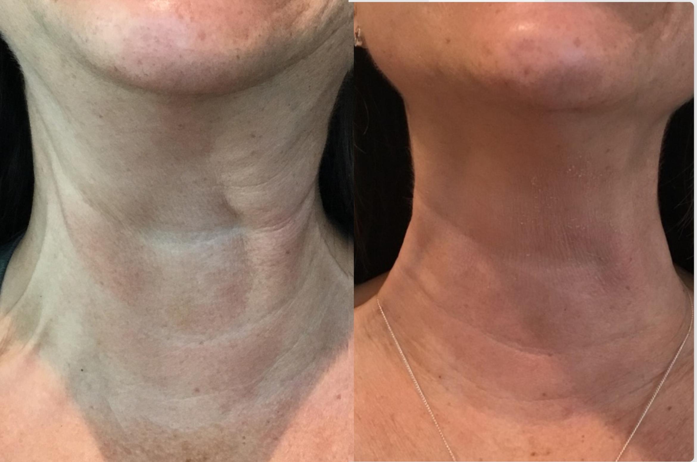 Before & After BOTOX® & Dysport Case 130 Front View in Sacramento, CA