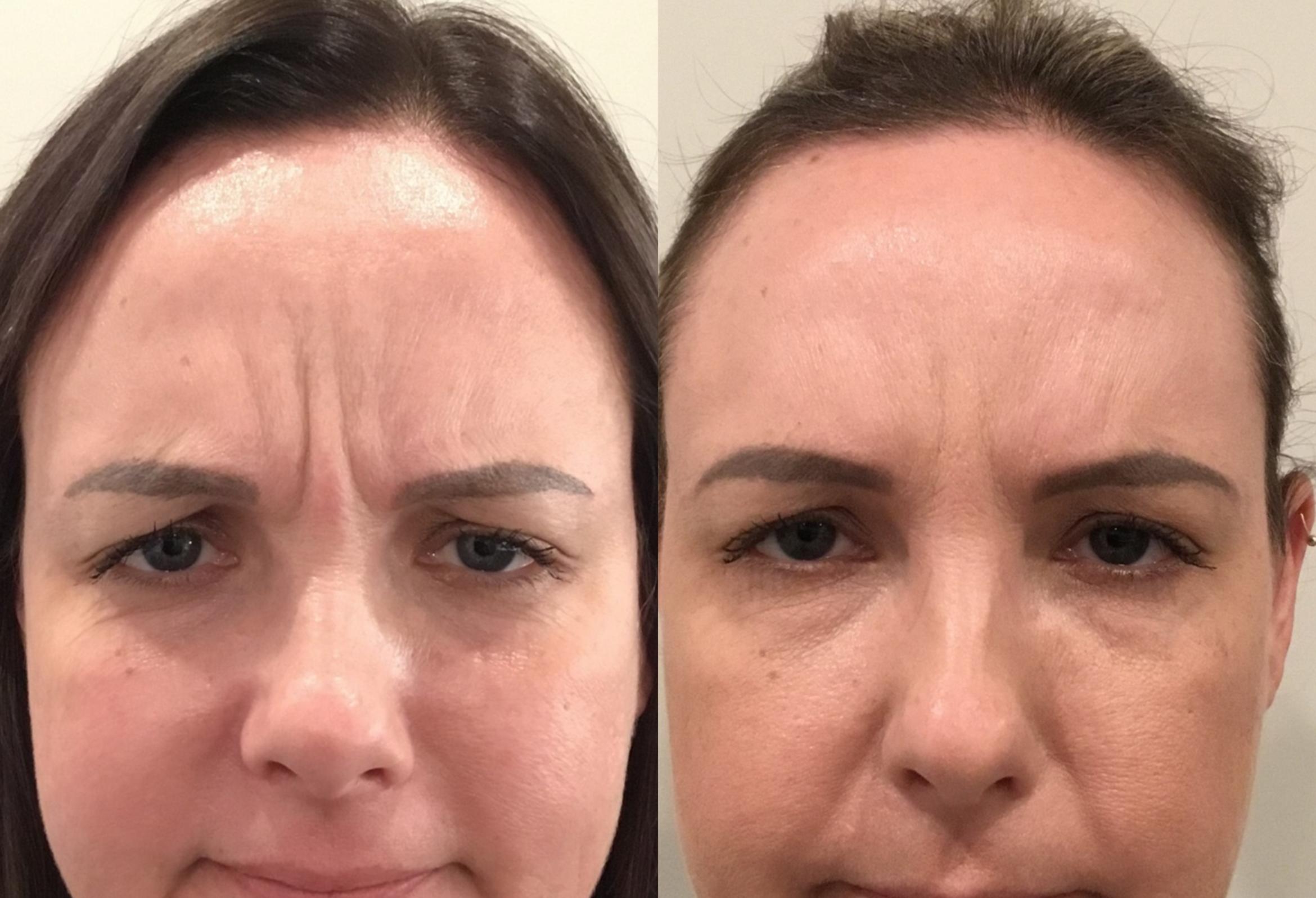 Before & After BOTOX® & Dysport Case 44 Front View in Sacramento, CA