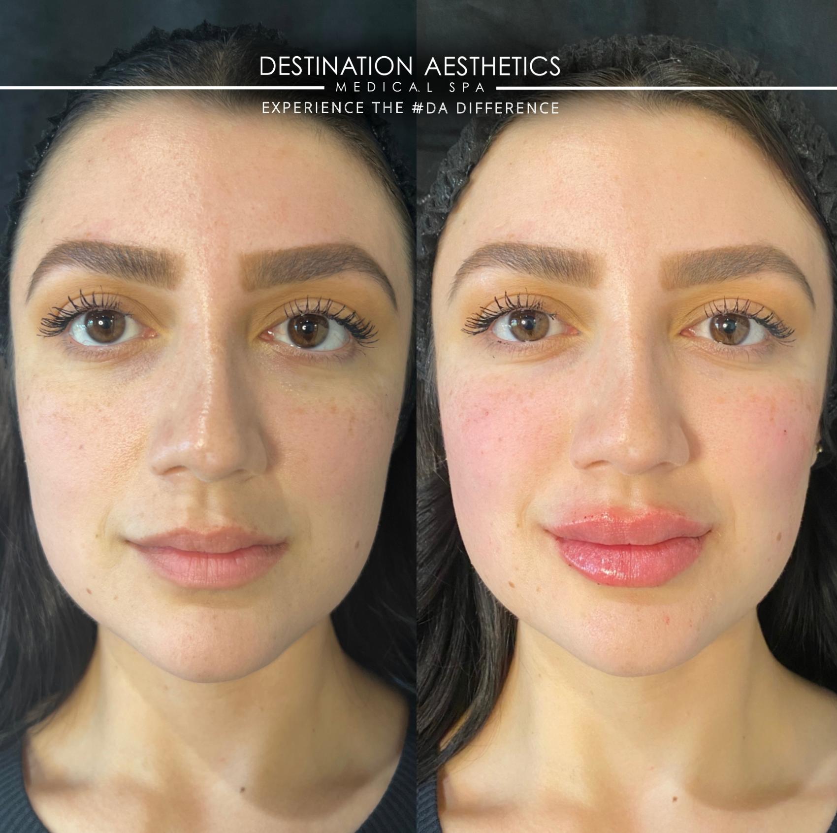 By Nurse Injectors: Clarissa + Demetria