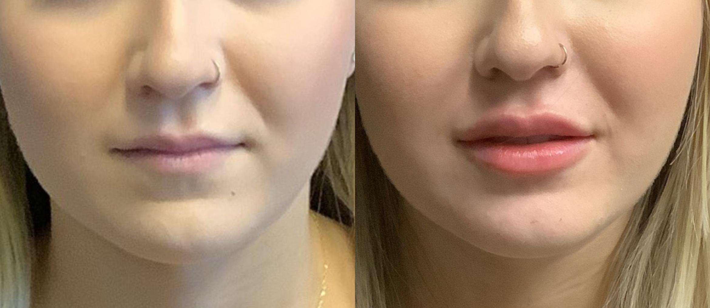 Dermal Fillers Case 84 Before & After Front | Elk Grove, Folsom, Roseville & Sacramento, CA | Destination Aesthetics