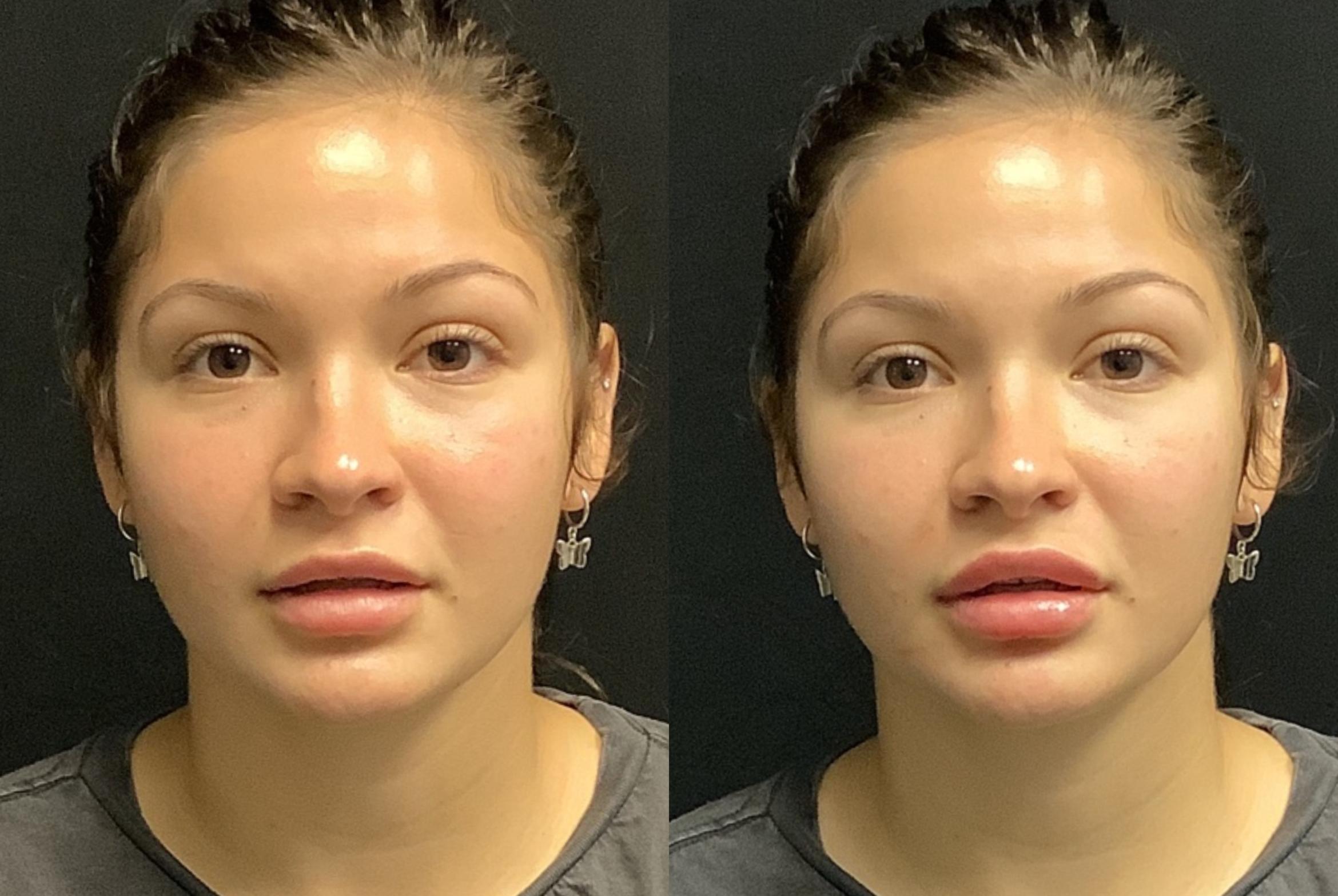 Dermal Fillers Case 86 Before & After Front | Elk Grove, Folsom, Roseville & Sacramento, CA | Destination Aesthetics