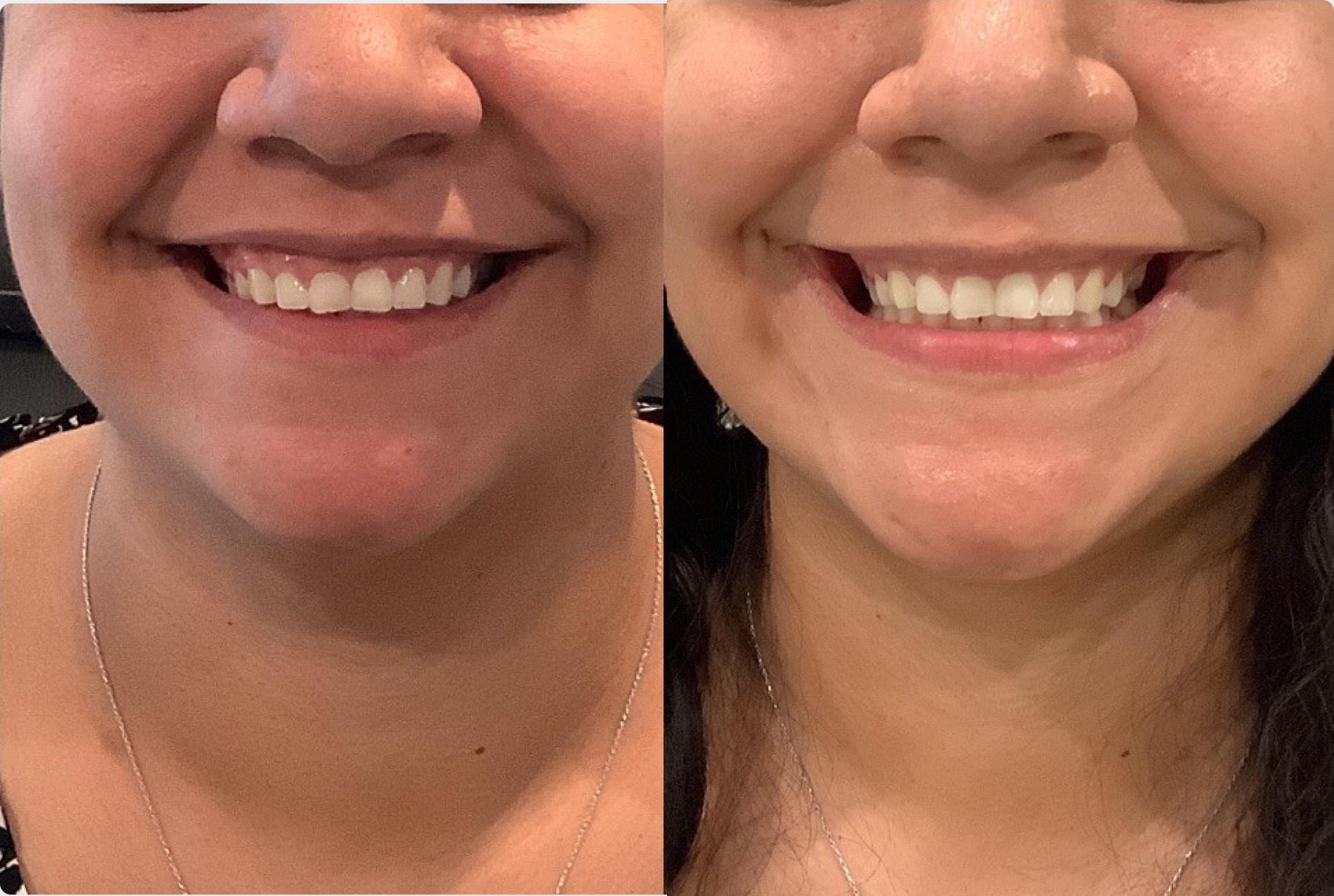 Before & After BOTOX® & Dysport Case 101 Front View in Sacramento, CA