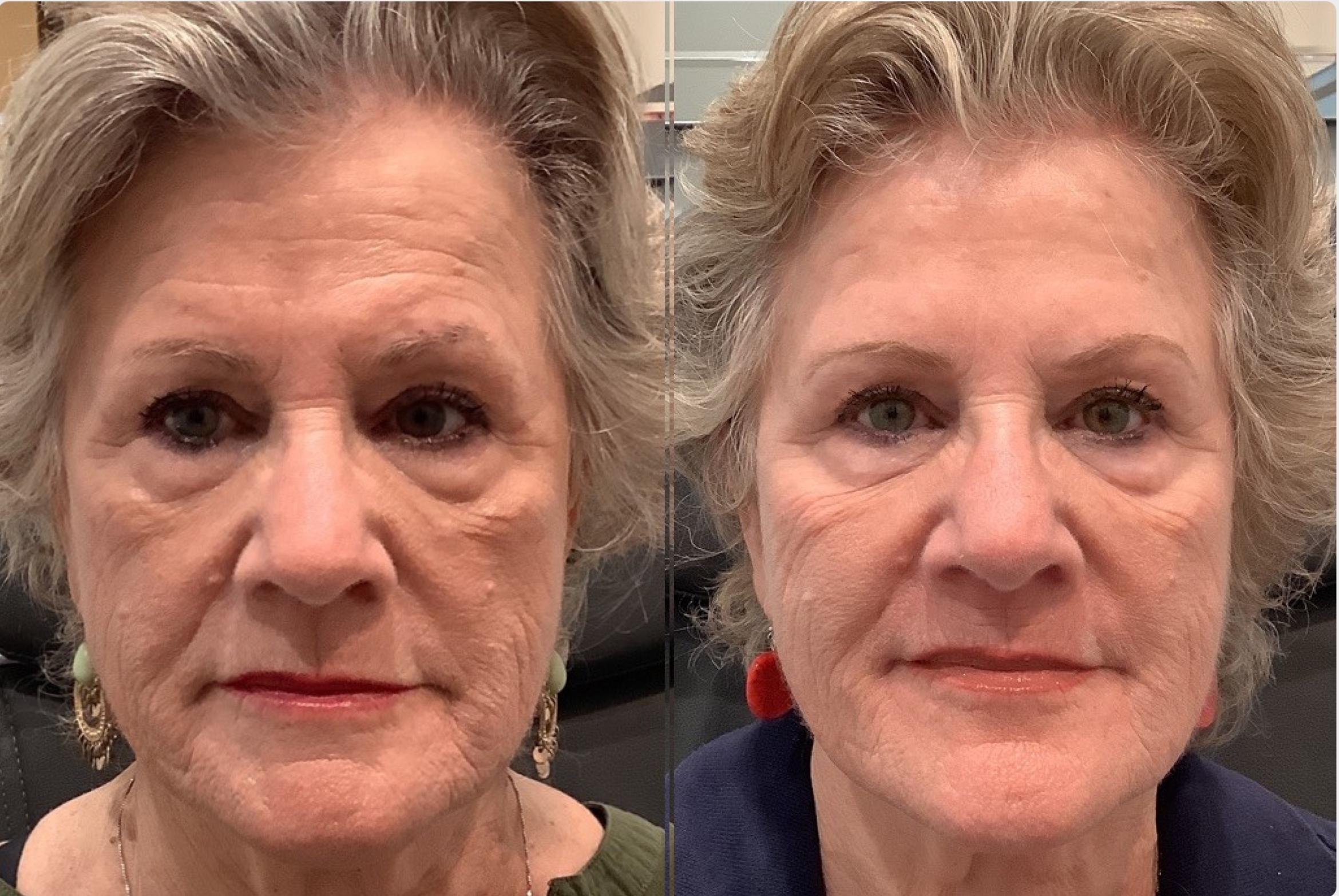 Before & After BOTOX® & Dysport Case 118 Right Side View in Sacramento, CA