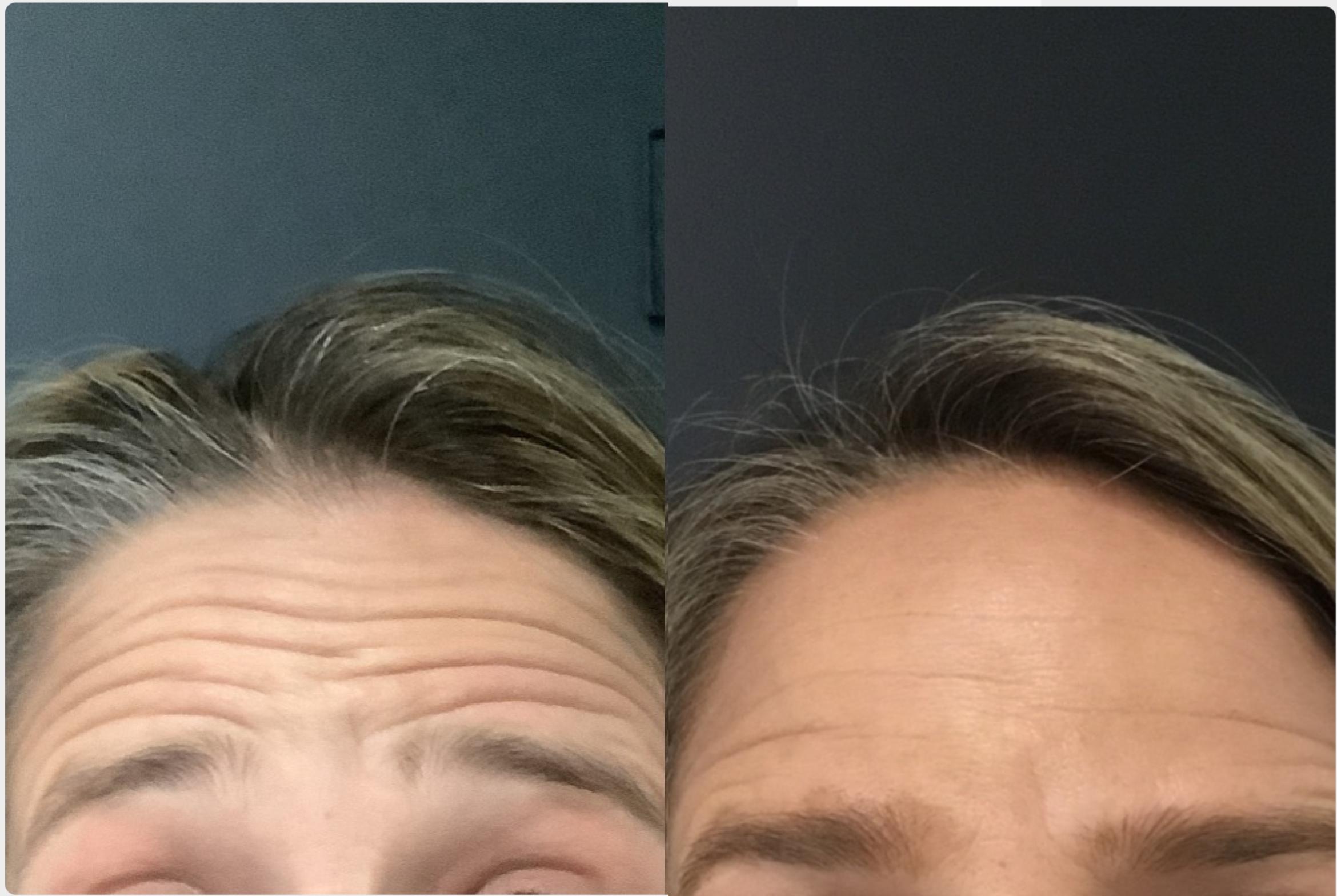 Before & After BOTOX® & Dysport Case 122 Front View in Sacramento, CA