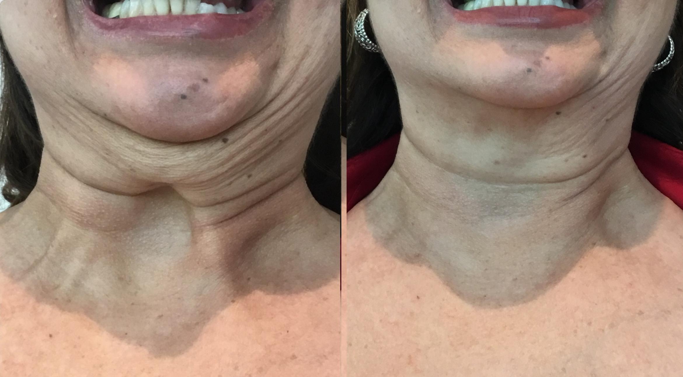 Before & After BOTOX® & Dysport Case 131 Front View in Sacramento, CA