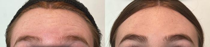 By Roseville Nurse Injector, Elle