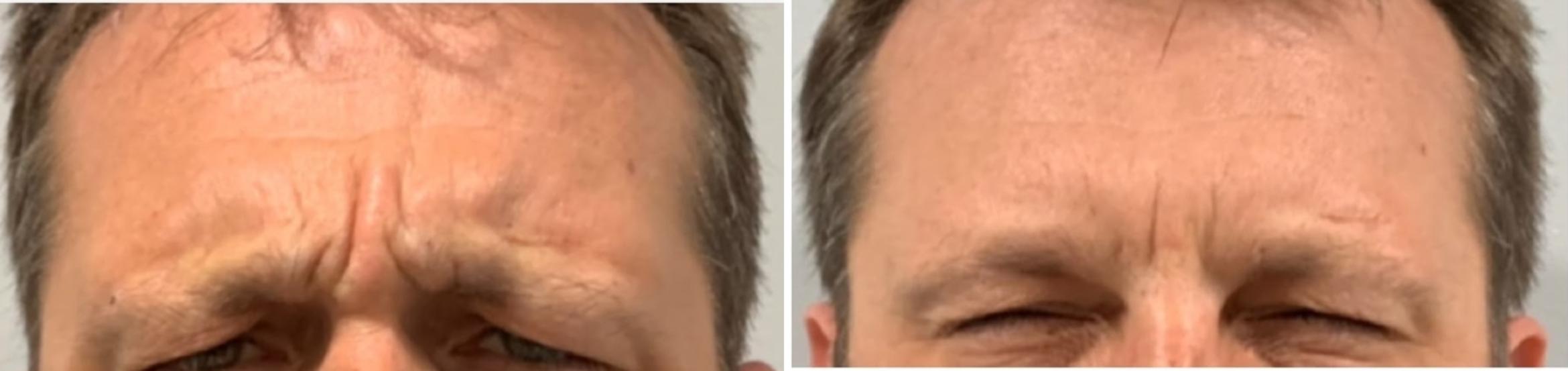 Before & After BOTOX® & Dysport Case 30 Front View in Sacramento, CA