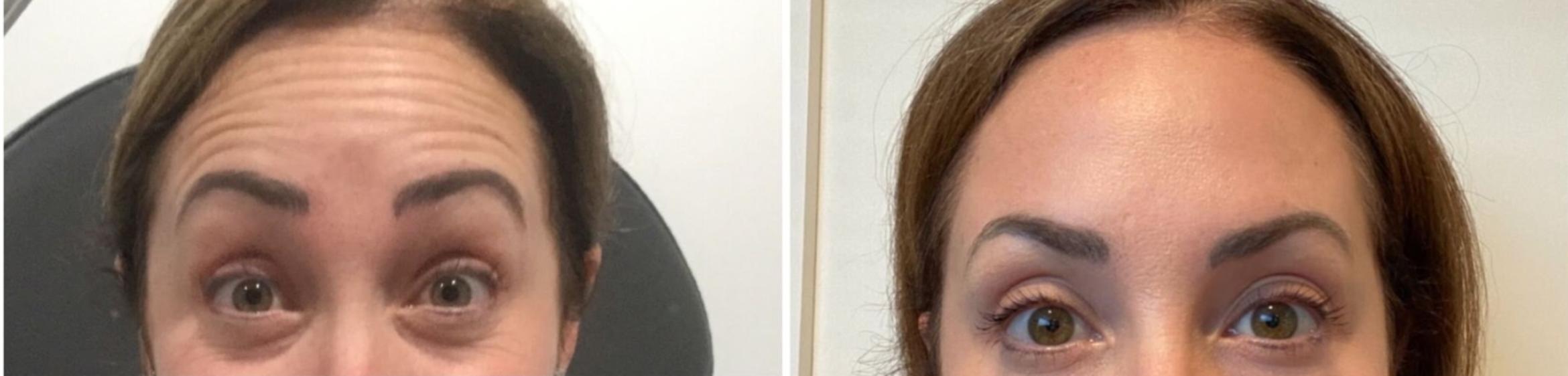 Before & After BOTOX® & Dysport Case 32 Front View in Sacramento, CA