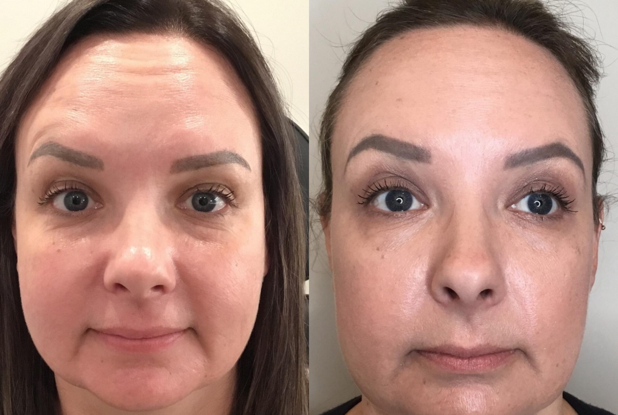 Before & After BOTOX® & Dysport Case 45 Front View in Sacramento, CA