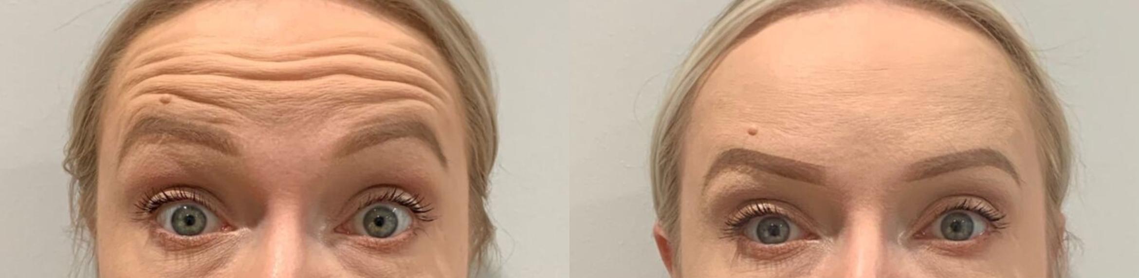 Before & After BOTOX® & Dysport Case 47 Front View in Sacramento, CA