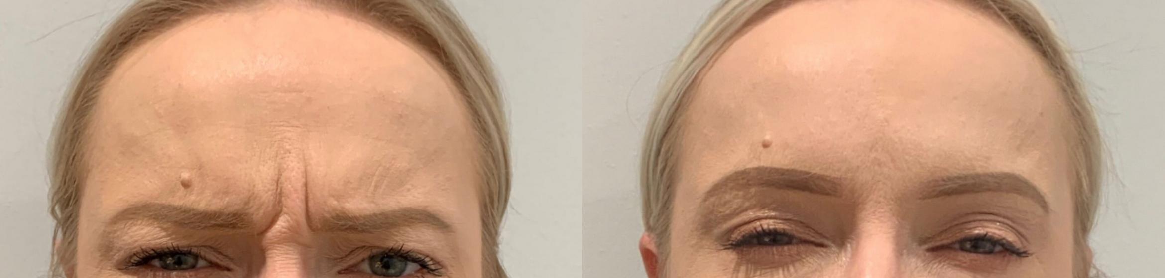 Before & After BOTOX® & Dysport Case 48 Front View in Sacramento, CA