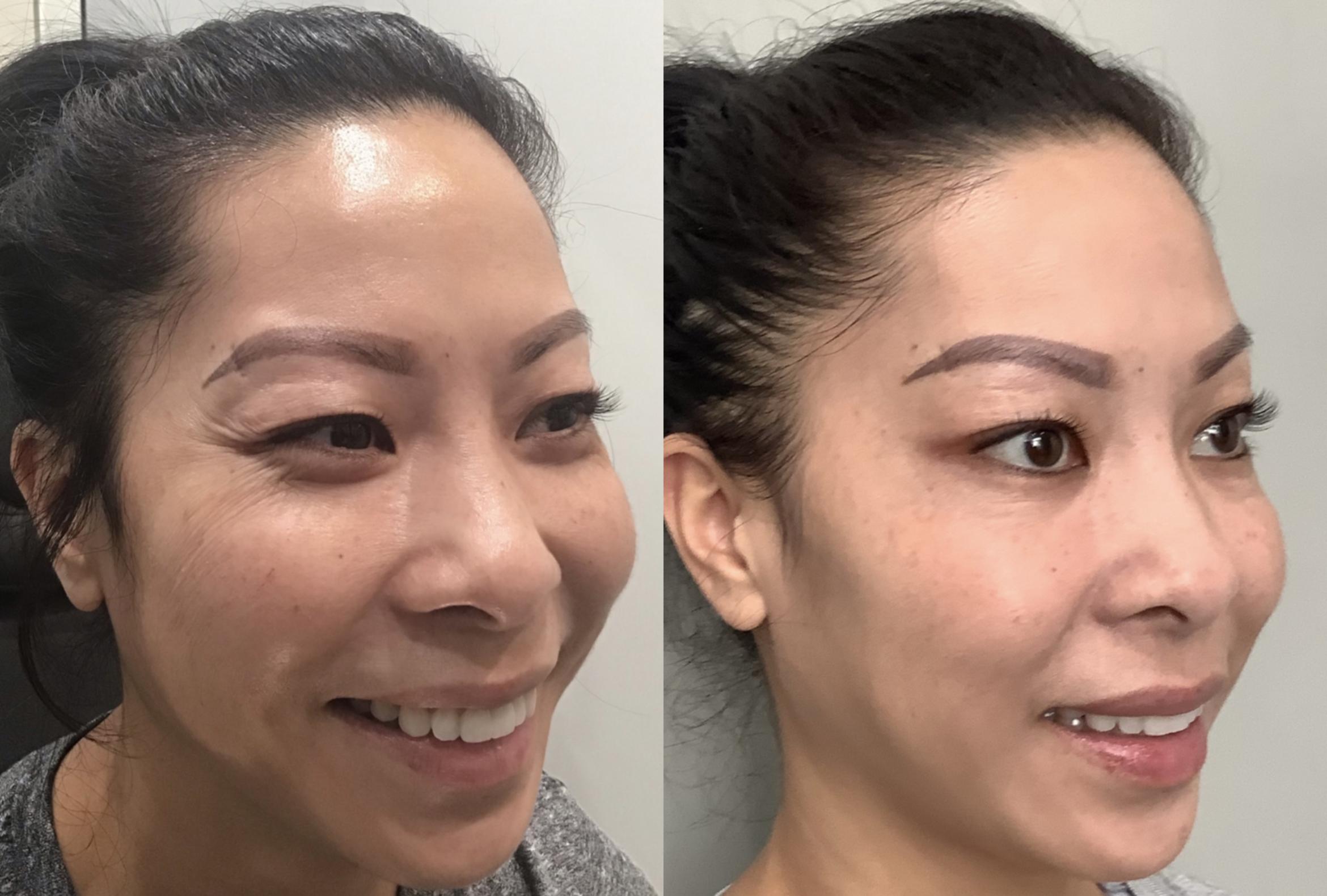 Before & After BOTOX® & Dysport Case 59 Right Side View in Sacramento, CA
