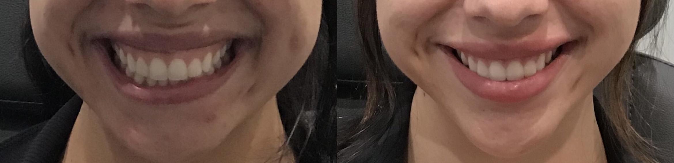 Before & After BOTOX® & Dysport Case 73 Front View in Sacramento, CA