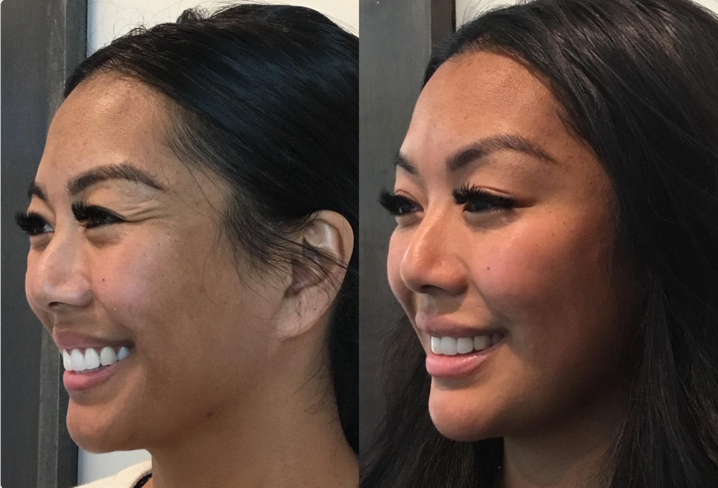 Before & After BOTOX® & Dysport Case 98 Left Side View in Sacramento, CA