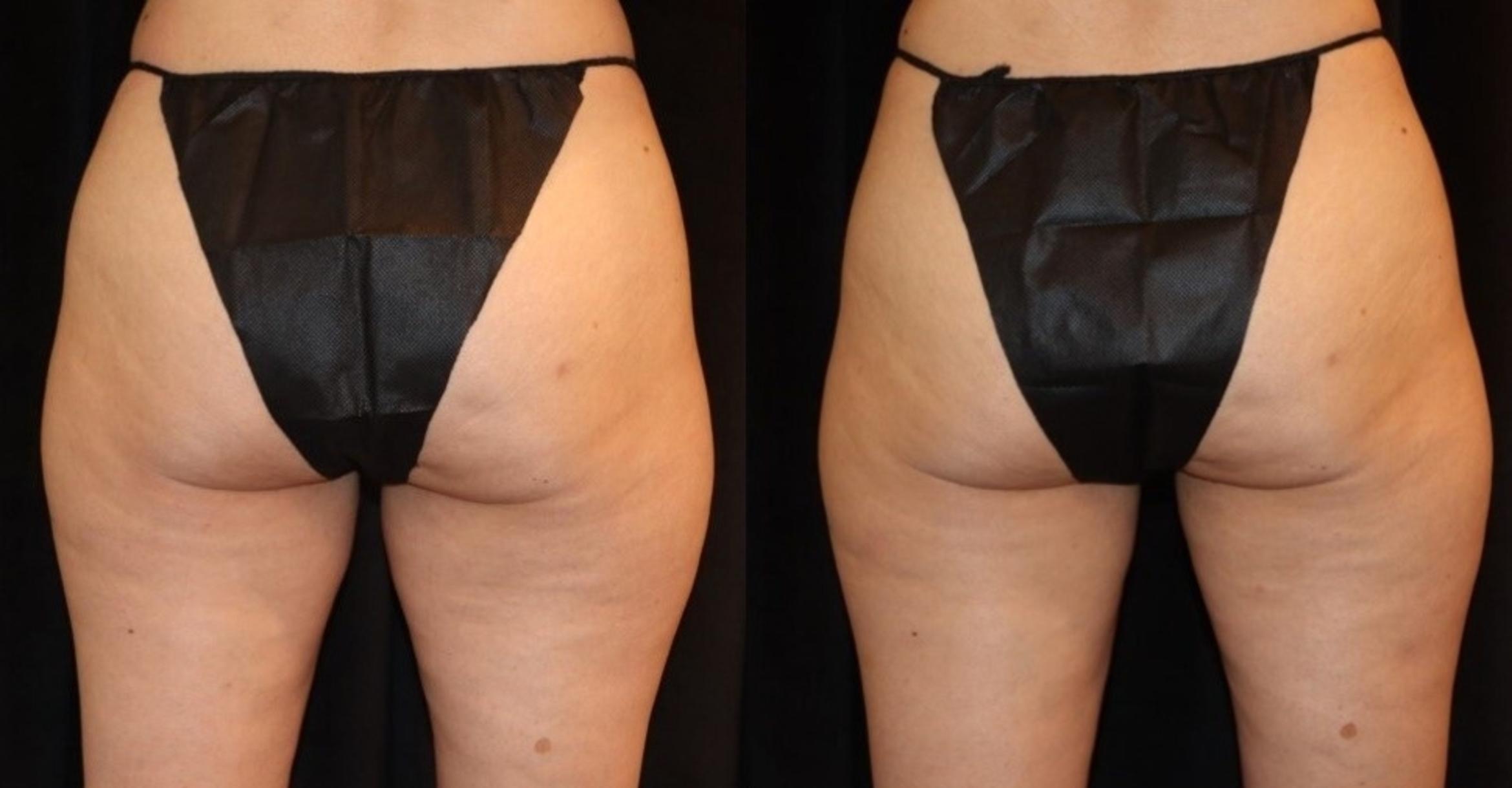 Before & After CoolSculpting® Case 105 Back View in Sacramento, CA
