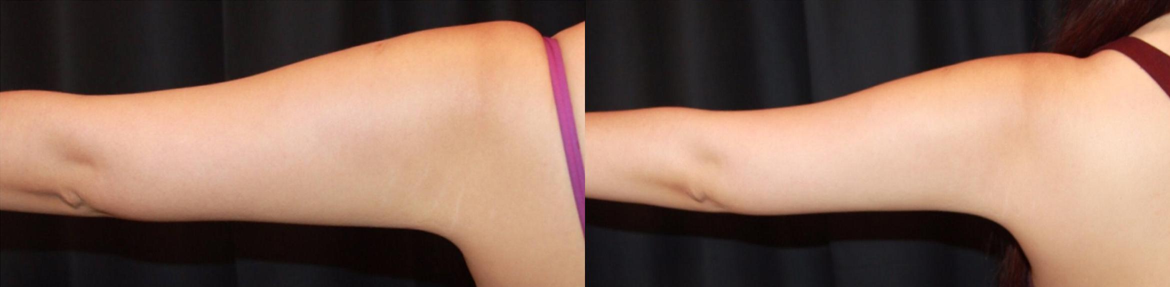 Before & After CoolSculpting® Case 5 Left Side View in Sacramento, CA