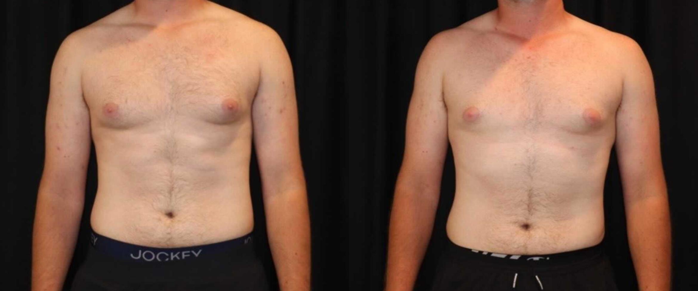 Before & After CoolSculpting® Case 50 Front View in Sacramento, CA