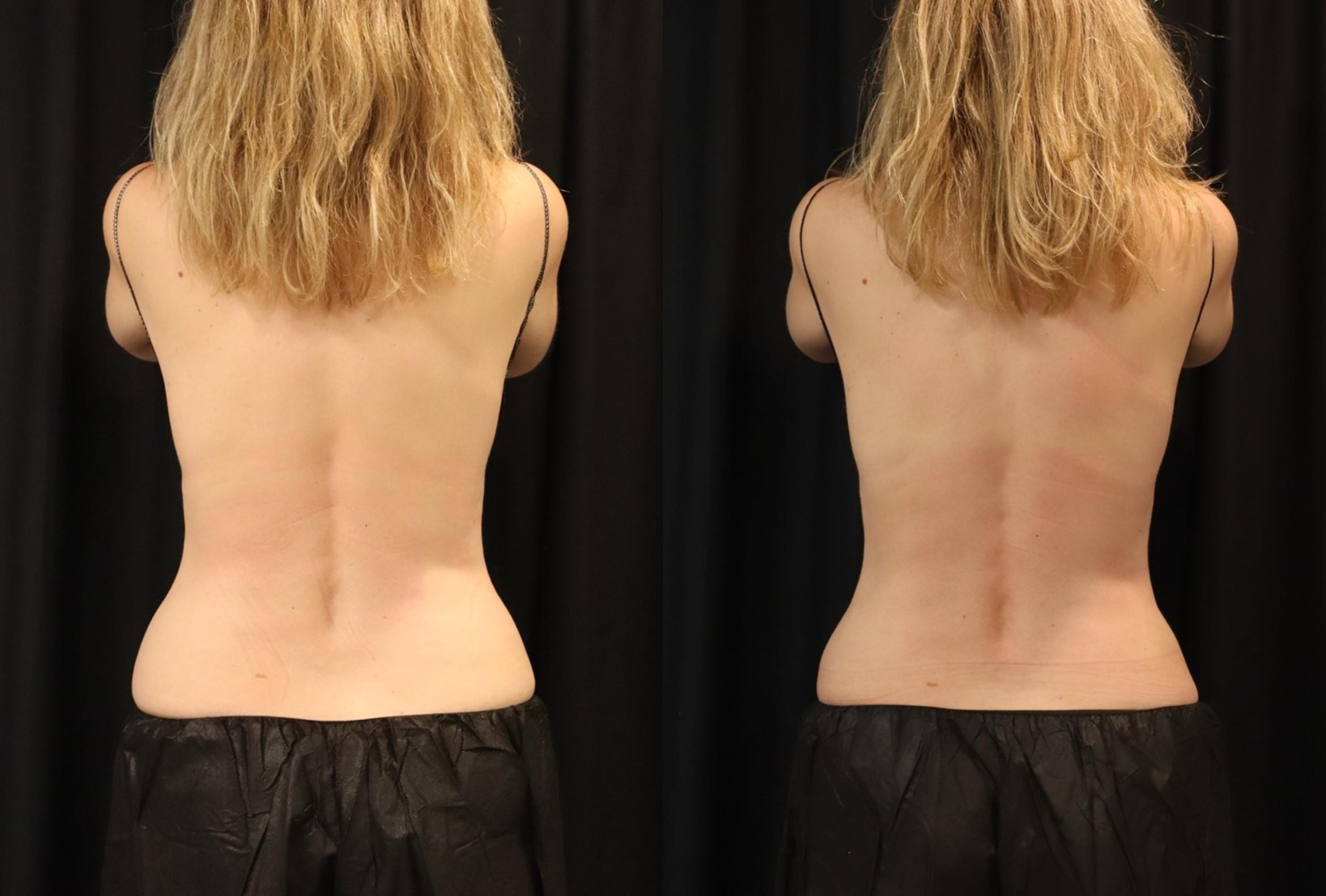 Before & After CoolSculpting® Case 76 Back View in Sacramento, CA