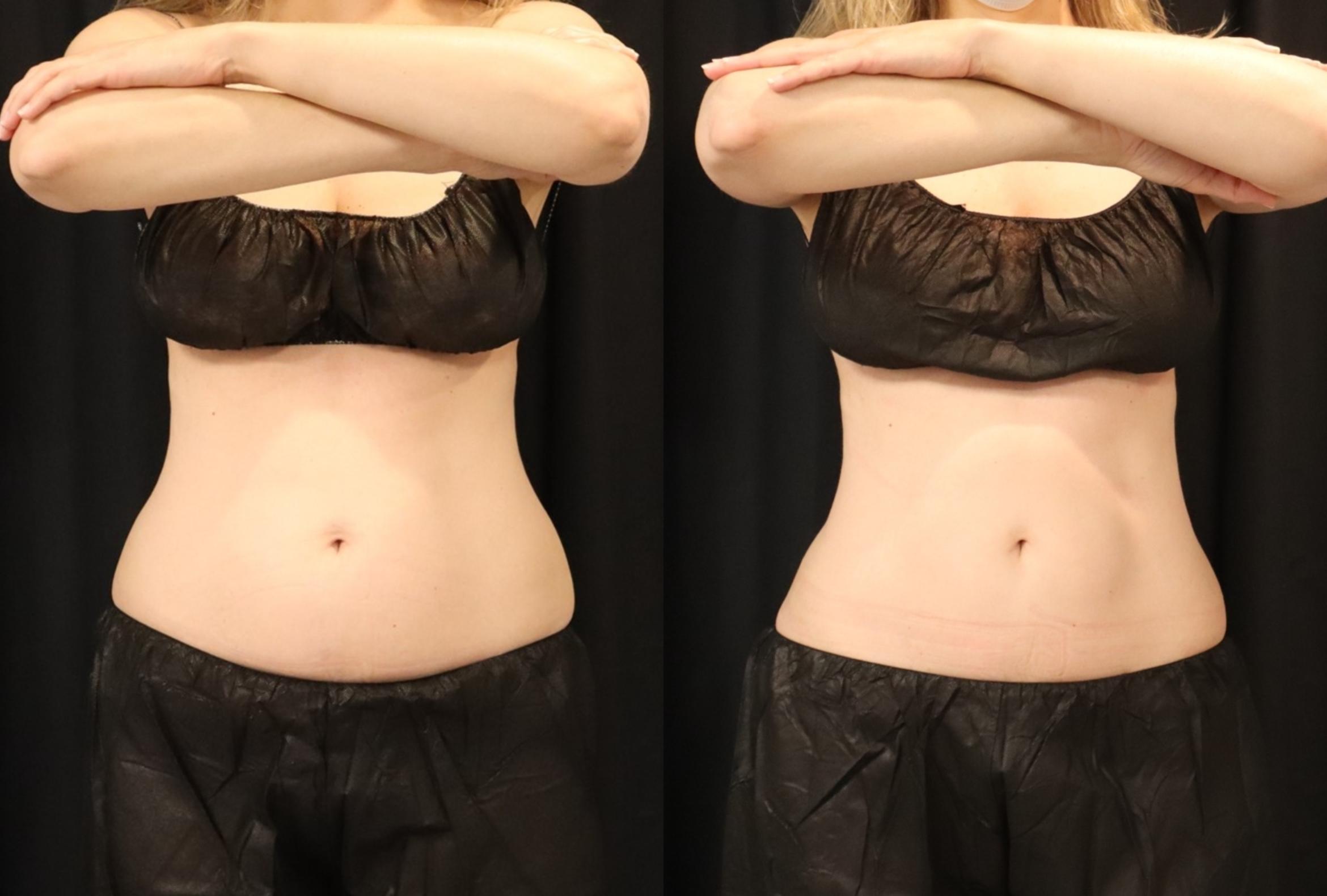 Before & After CoolSculpting® Case 76 Front View in Sacramento, CA