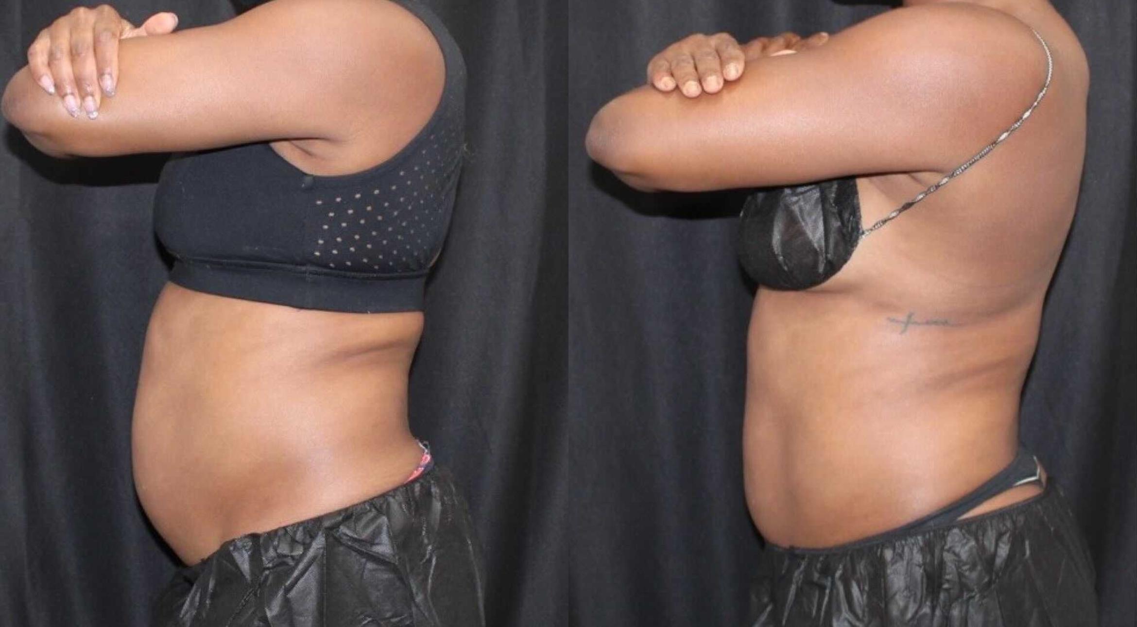 Before & After CoolSculpting® Case 80 Left Side View in Sacramento, CA