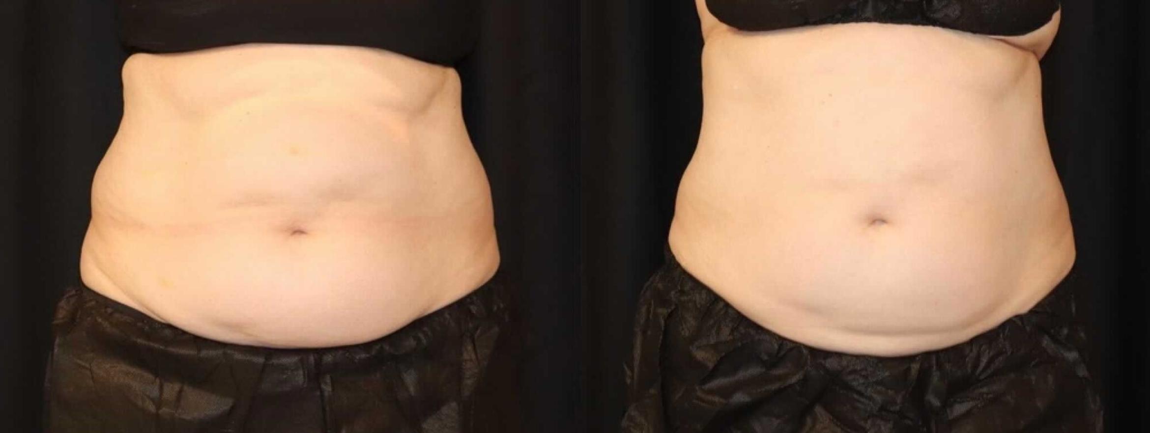 Before & After CoolSculpting® Case 90 Front View in Sacramento, CA