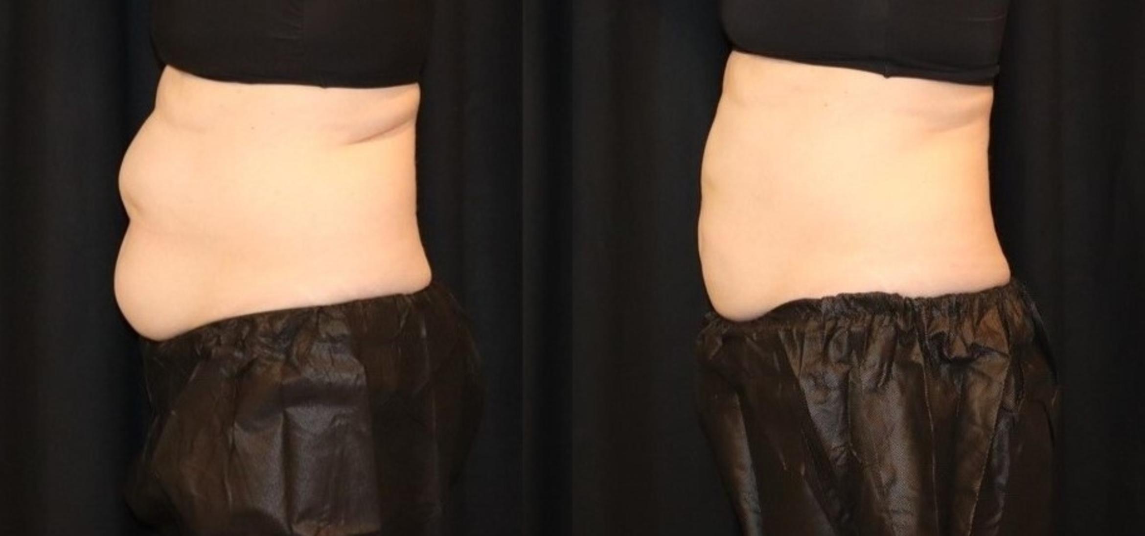 Before & After CoolSculpting® Case 90 Left Side View in Sacramento, CA