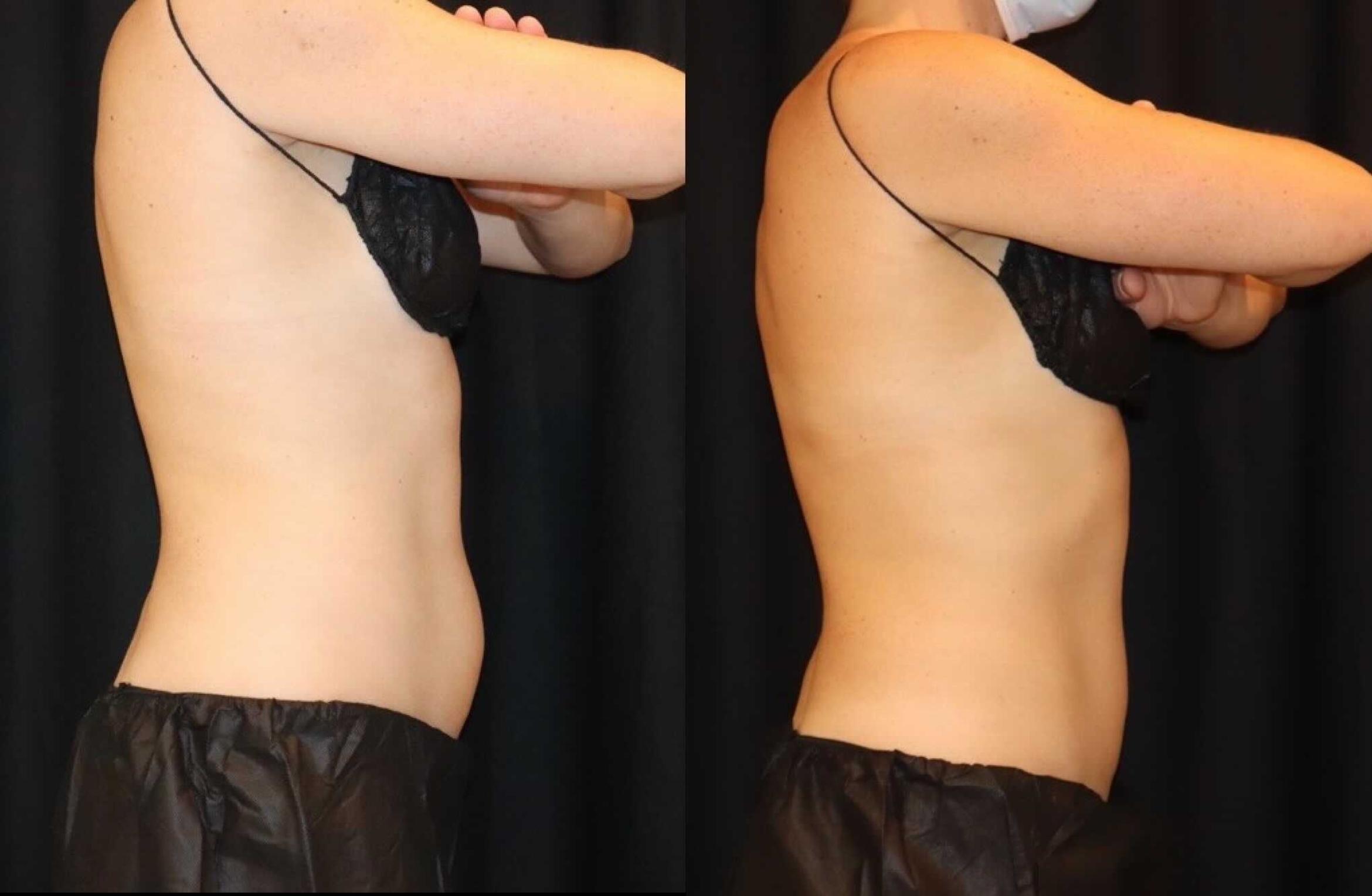 Before & After CoolSculpting® Case 99 Right Side View in Sacramento, CA