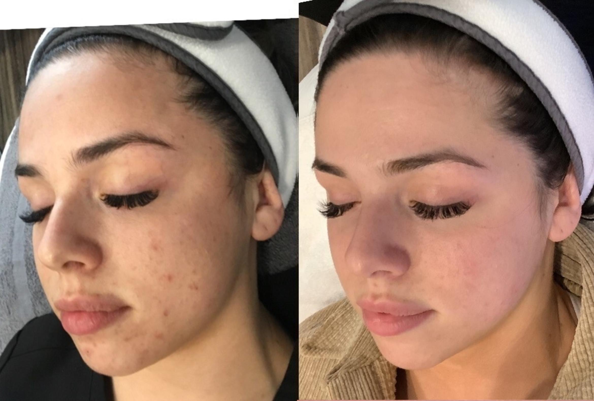 Before & After DA Acne Case 117 Front View in Sacramento, CA