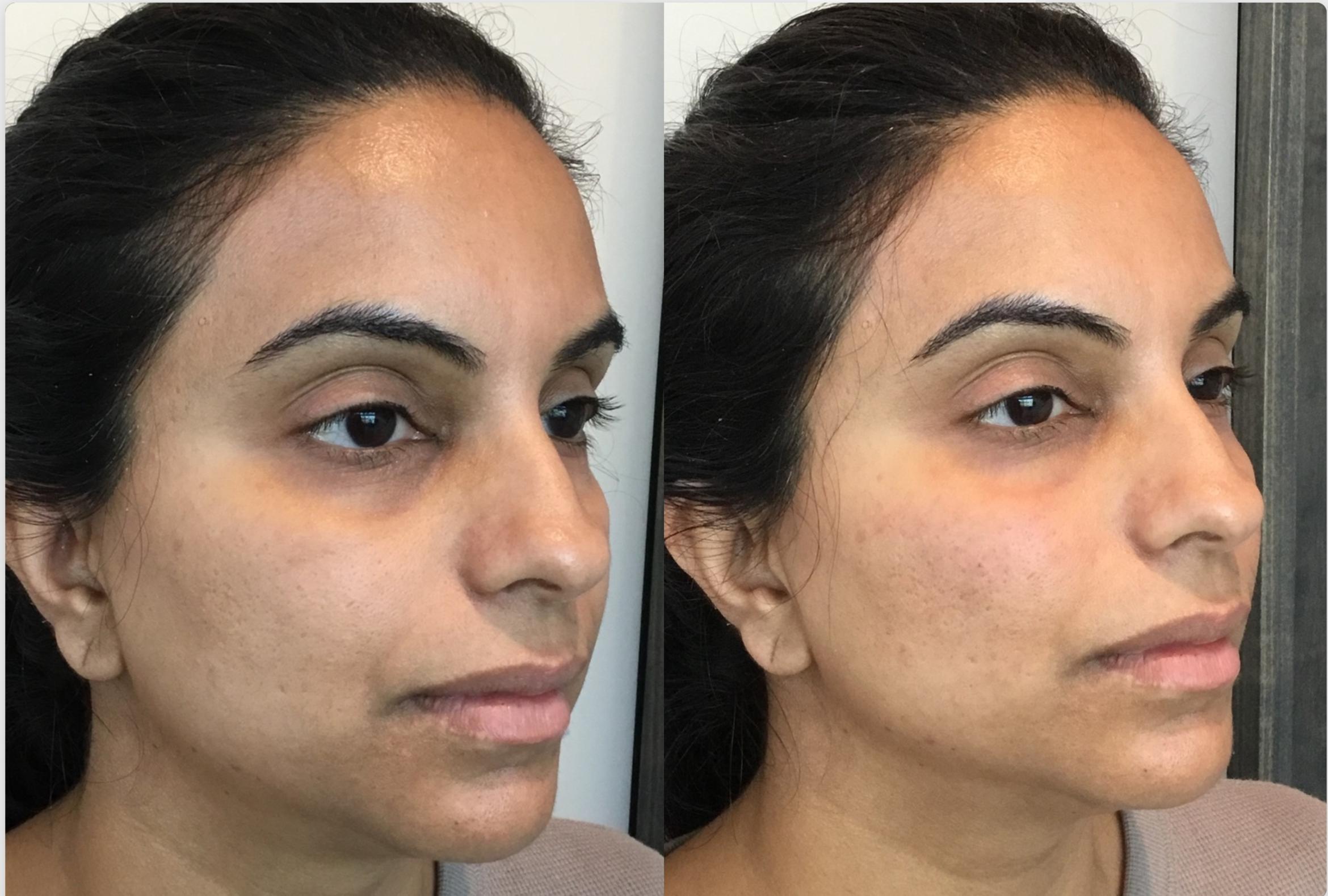 Before & After Dermal Fillers Case 111 Right Side View in Sacramento, CA