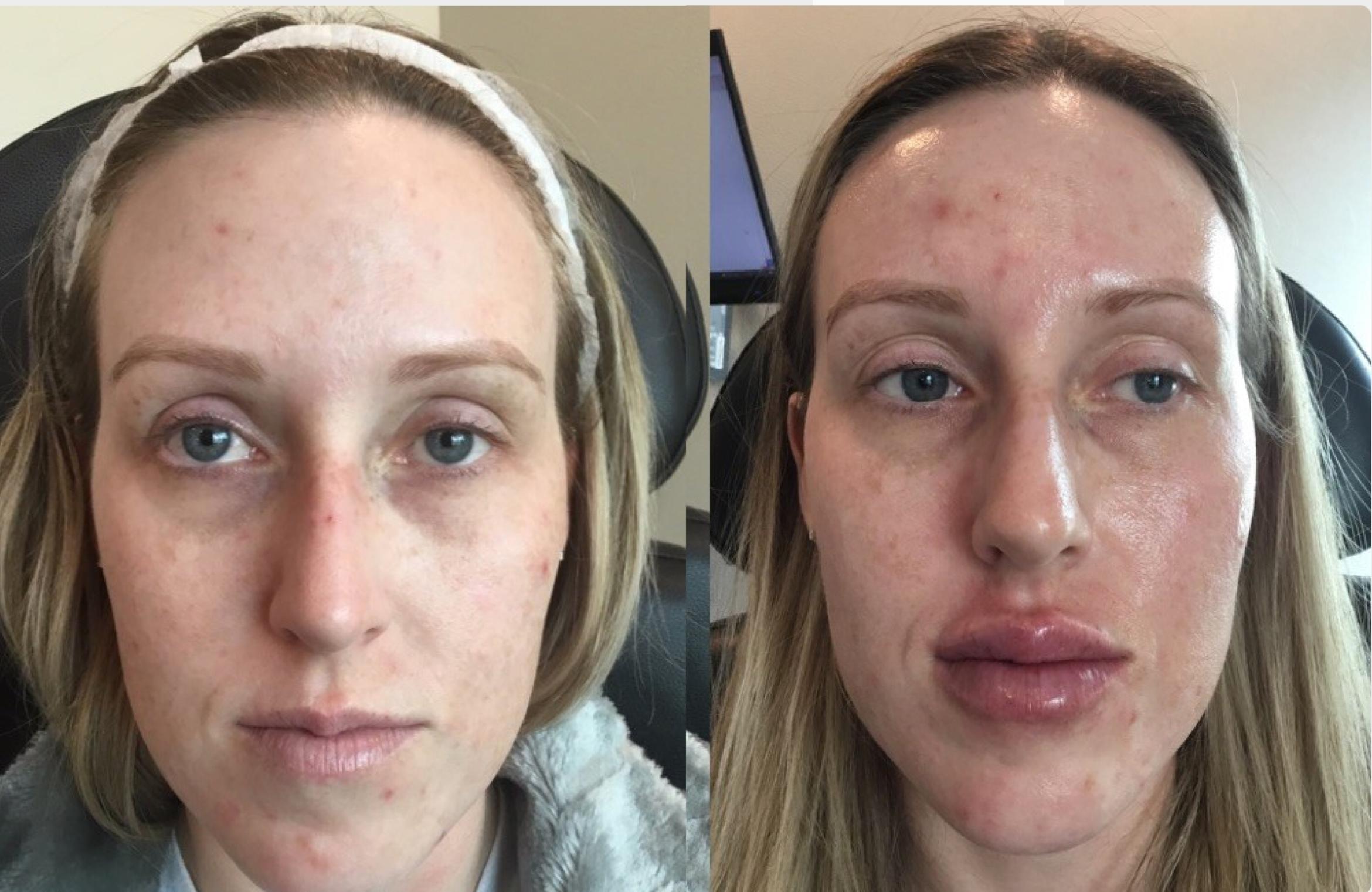 Before & After Dermal Fillers Case 115 Front View in Sacramento, CA