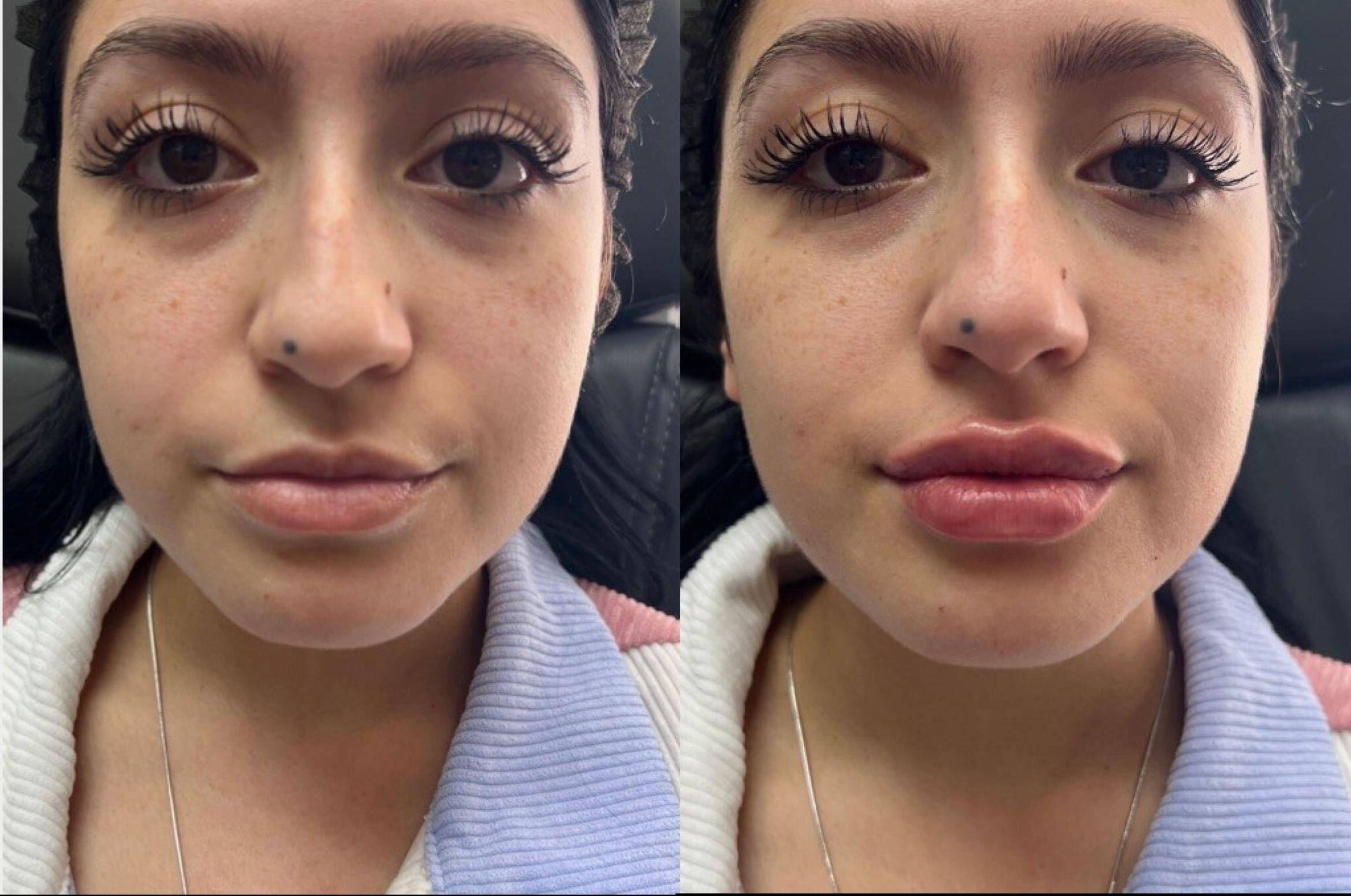Before & After Dermal Fillers Case 121 Front View in Sacramento, CA