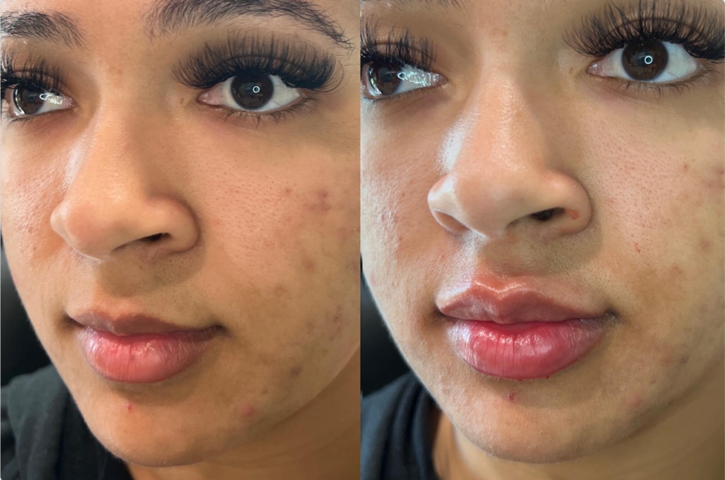 Before & After Dermal Fillers Case 123 Right Side View in Sacramento, CA