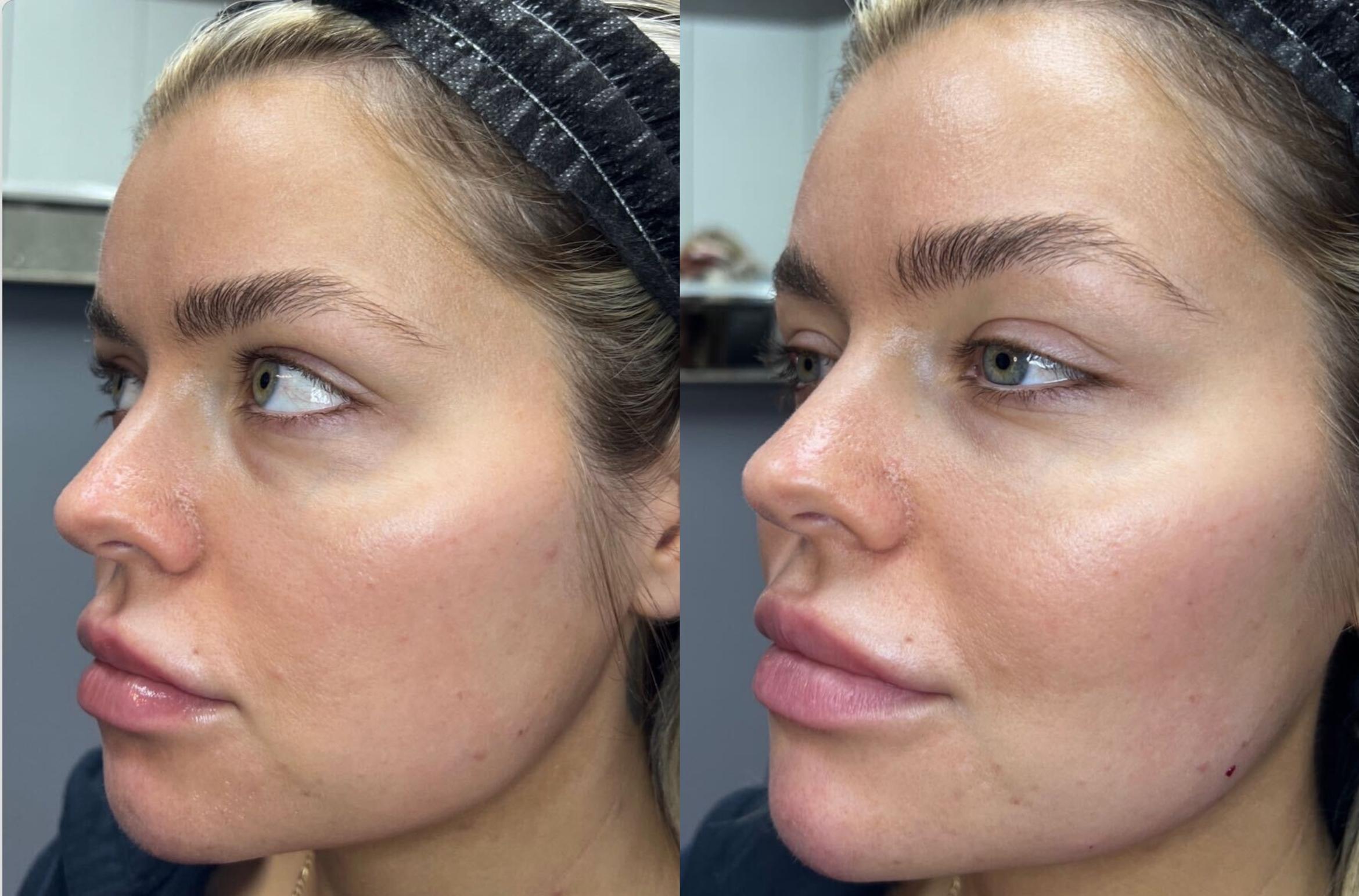 Before & After Dermal Fillers Case 126 Front View in Sacramento, CA