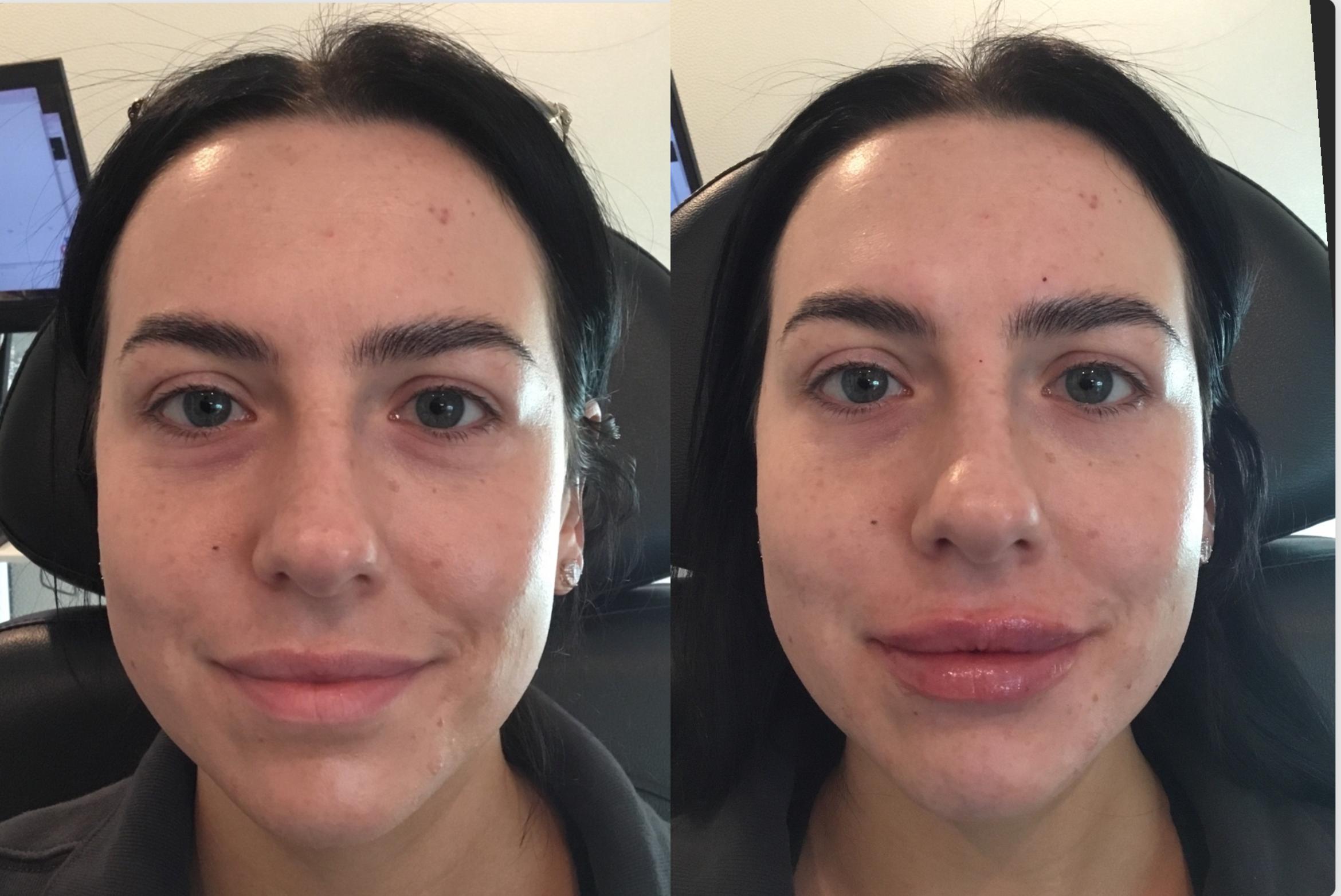 Before & After Dermal Fillers Case 127 Front View in Sacramento, CA
