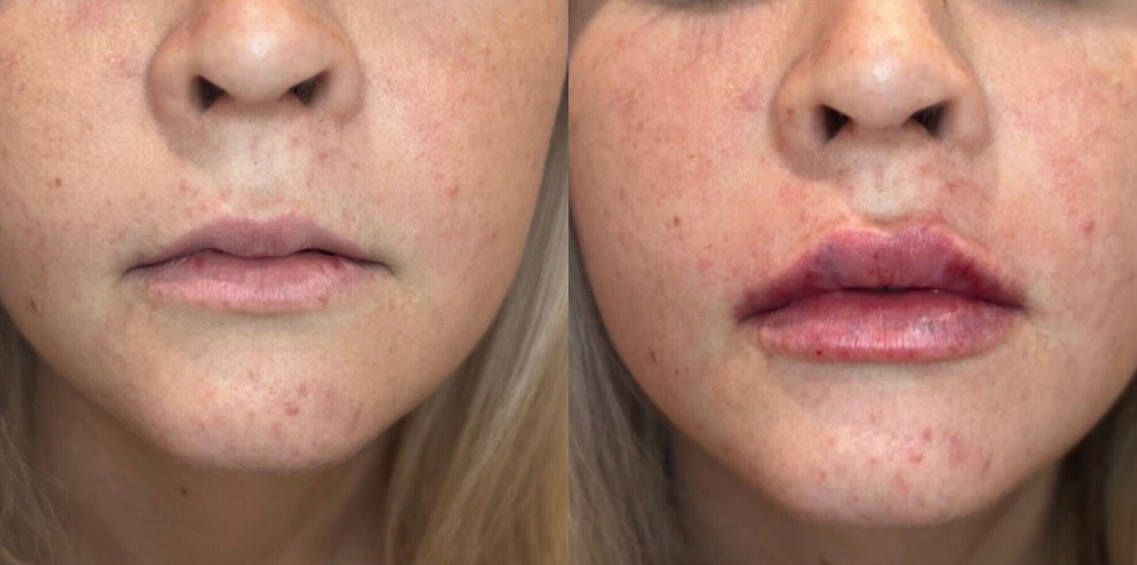 Before & After Dermal Fillers Case 132 Front View in Sacramento, CA