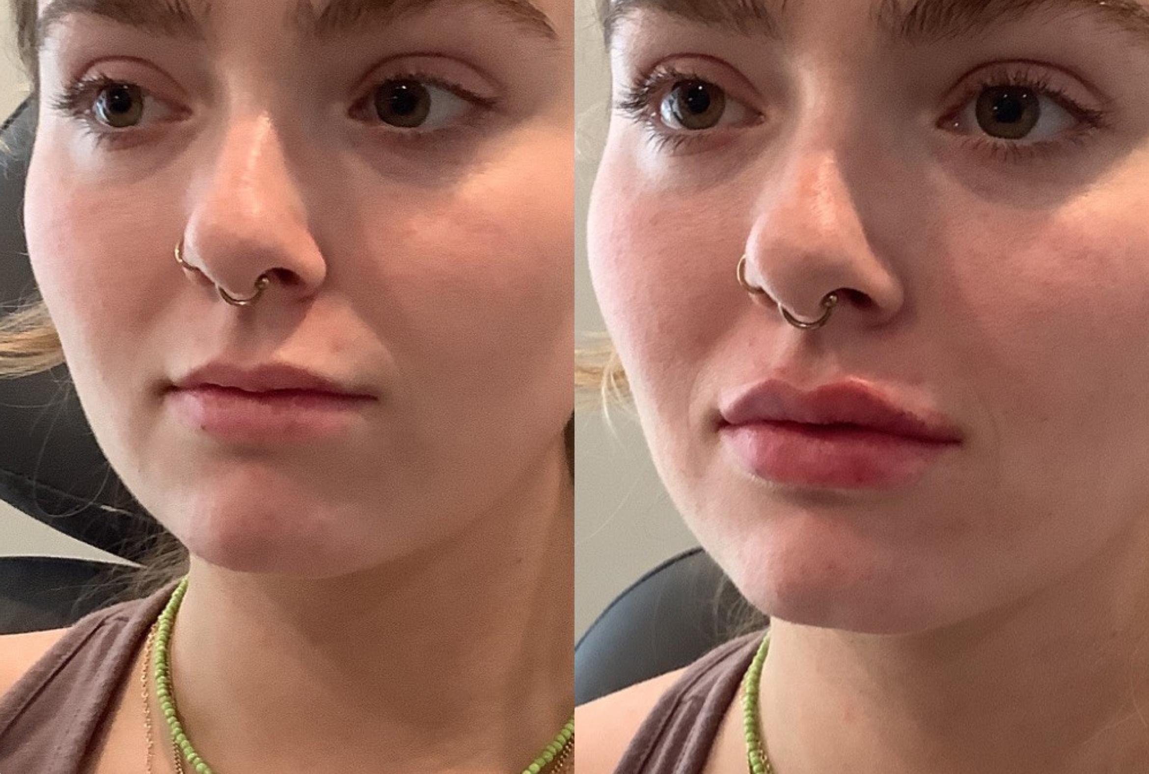 Before & After Dermal Fillers Case 133 Left Side View in Sacramento, CA