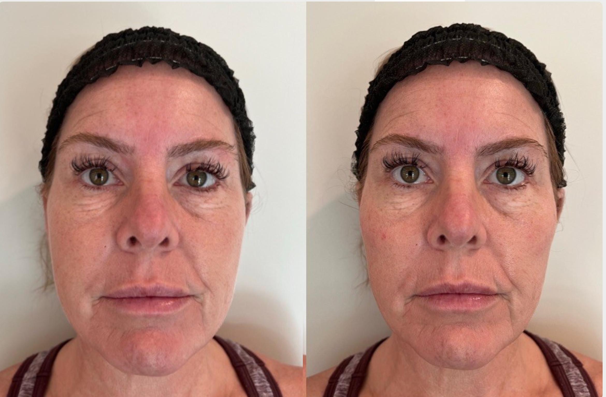 Before & After Dermal Fillers Case 134 Front View in Sacramento, CA