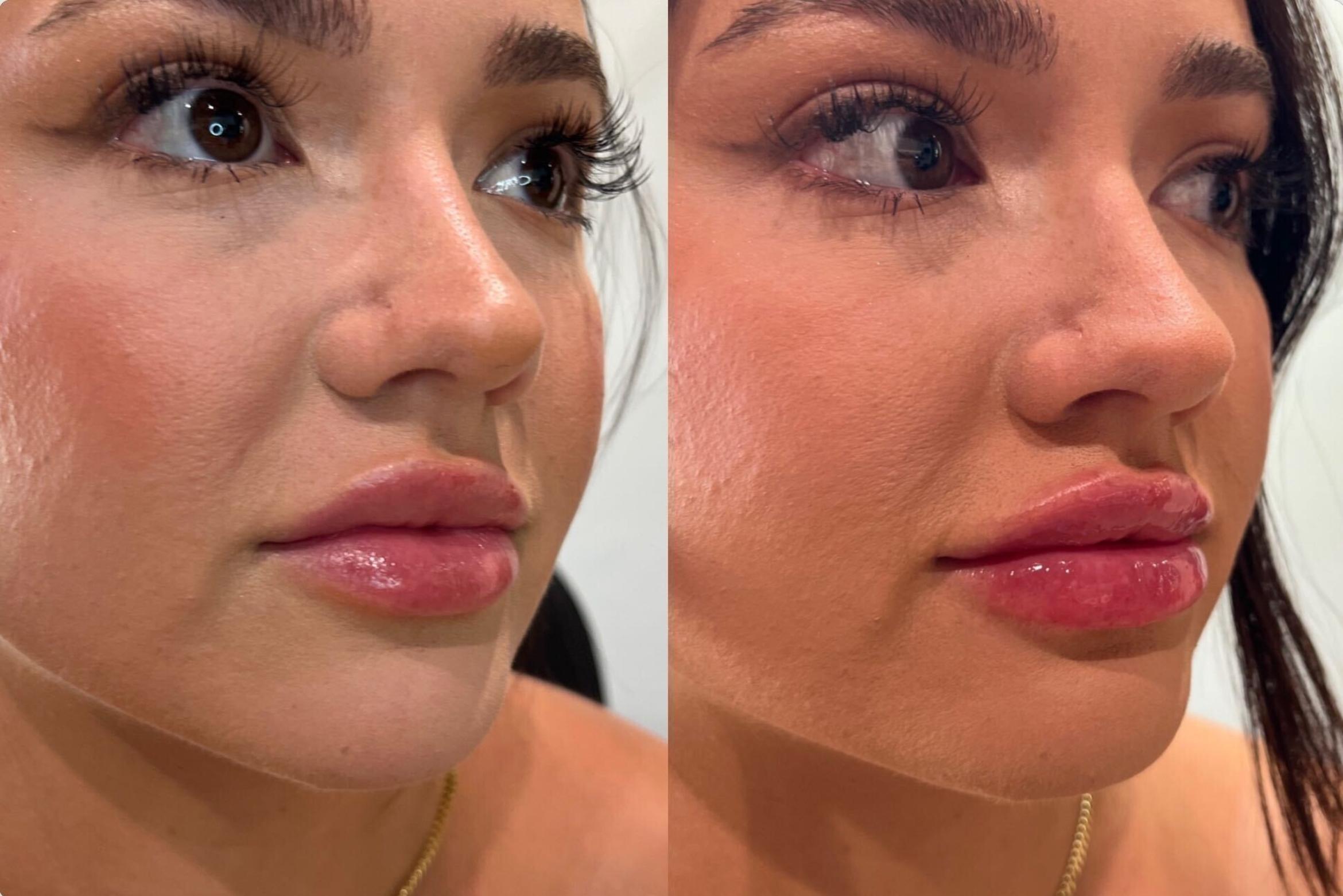 Before & After Dermal Fillers Case 135 Right Side View in Sacramento, CA