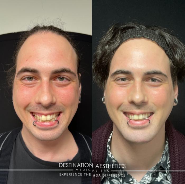 Before & After Dermal Fillers Case 159 Front View in Sacramento, CA