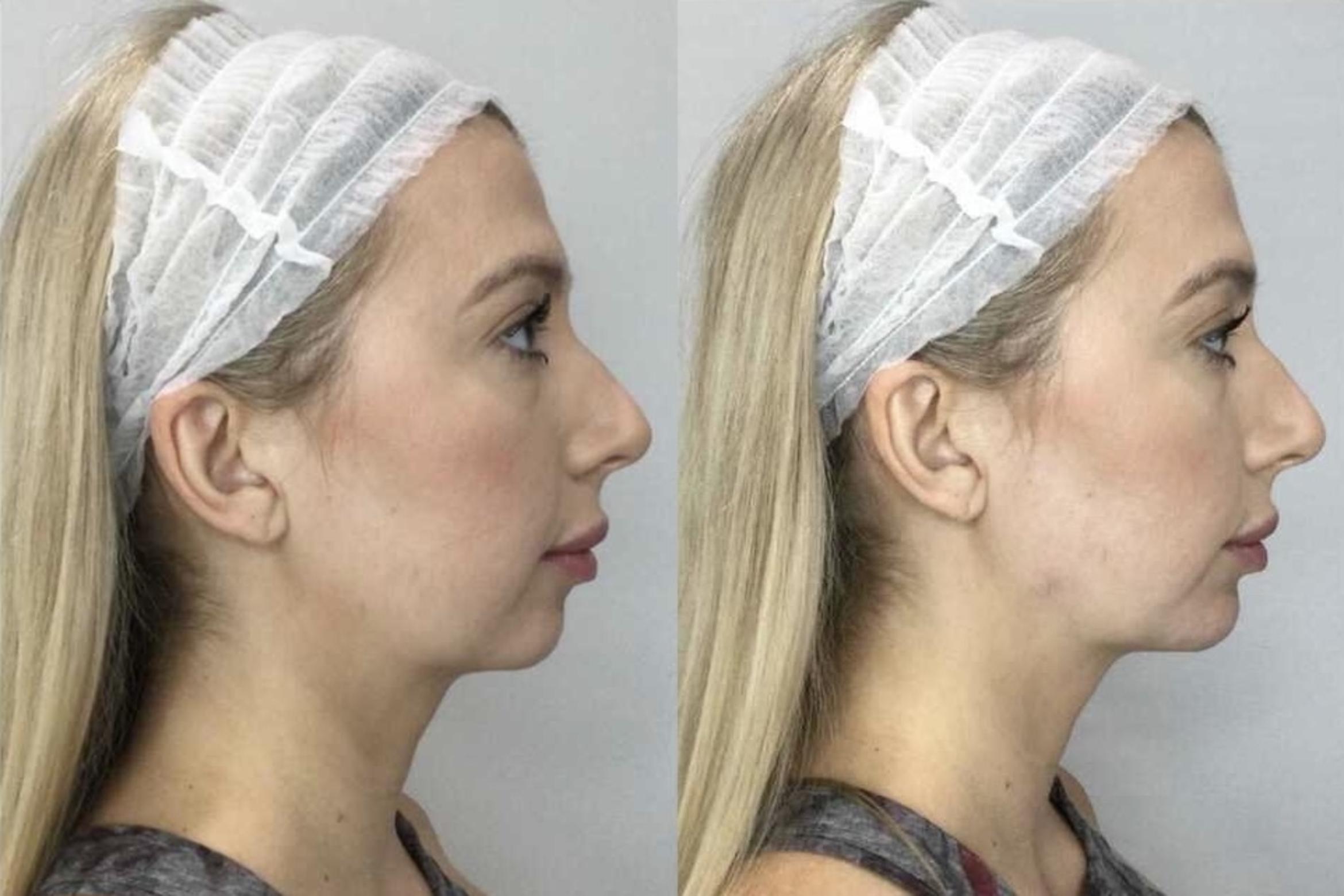 Before & After Dermal Fillers Case 22 Right Side View in Sacramento, CA