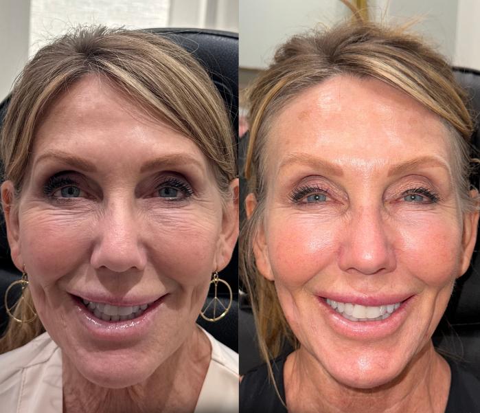 Before & After Dermal Fillers Case 222 Front Smiling View in Sacramento, CA