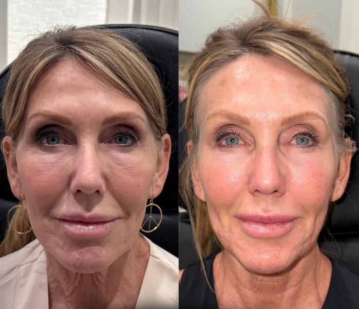 Before & After Dermal Fillers Case 222 Front View in Sacramento, CA