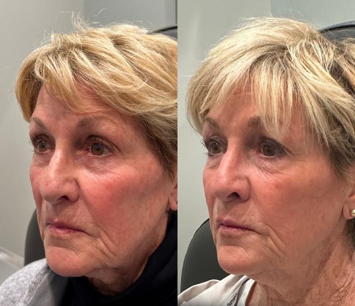 Before & After Dermal Fillers Case 223 Left Side View in Sacramento, CA