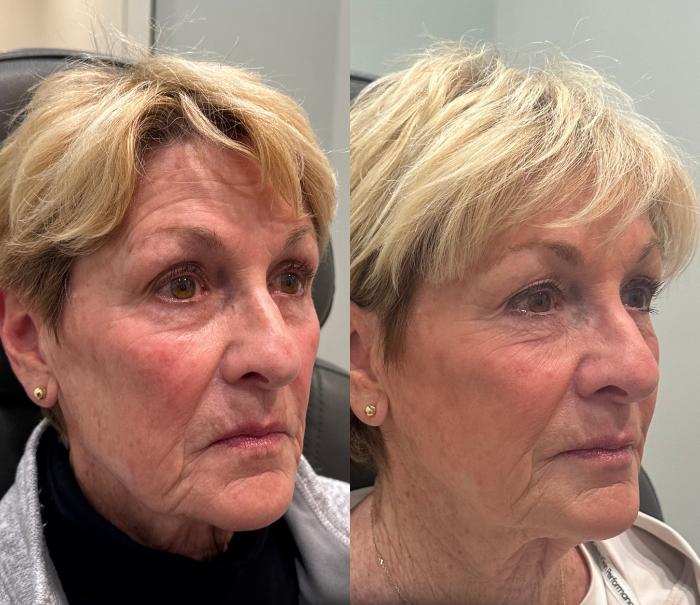 Before & After Dermal Fillers Case 223 Right Side View in Sacramento, CA