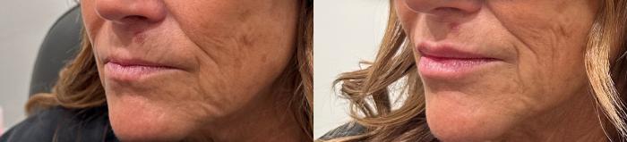 Before & After Dermal Fillers Case 224 Left Side View in Sacramento, CA