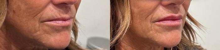 Before & After Dermal Fillers Case 224 Right Side View in Sacramento, CA