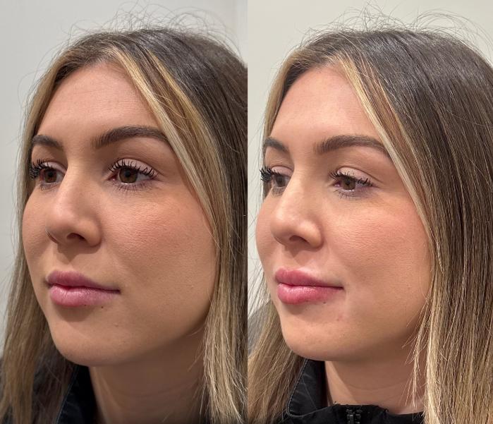 Before & After Dermal Fillers Case 225 Left Side View in Sacramento, CA