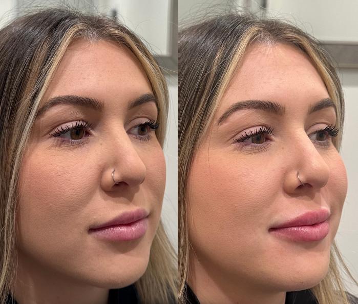 Before & After Dermal Fillers Case 225 Right Side View in Sacramento, CA