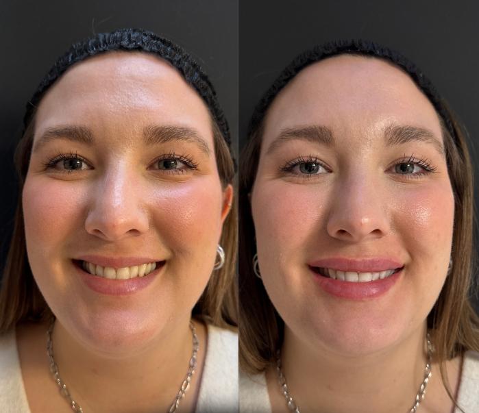 Before & After Dermal Fillers Case 226 Front Smile View in Sacramento, CA