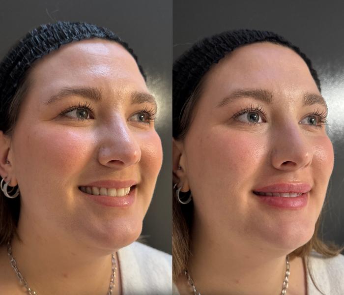 Before & After Dermal Fillers Case 226 Left Oblique View in Sacramento, CA